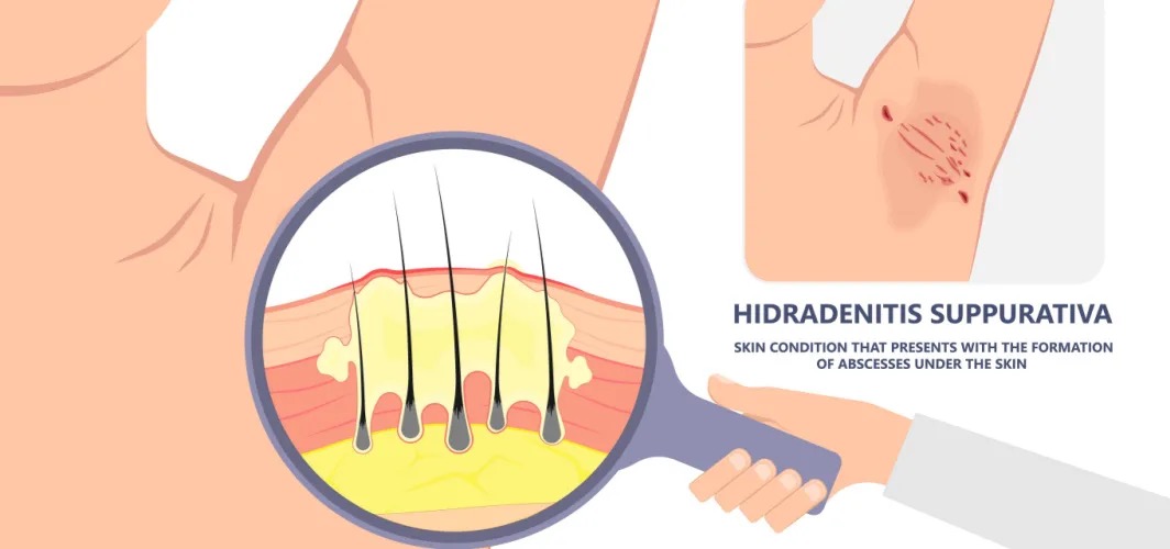 Hidradenitis Suppurativa – Specialised Care & Personalised Treatment Plans at Sensitif Laser Clinic